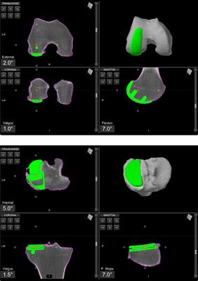 Short term outcomes following robotic arm-assisted lateral unicompartmental knee arthroplasty